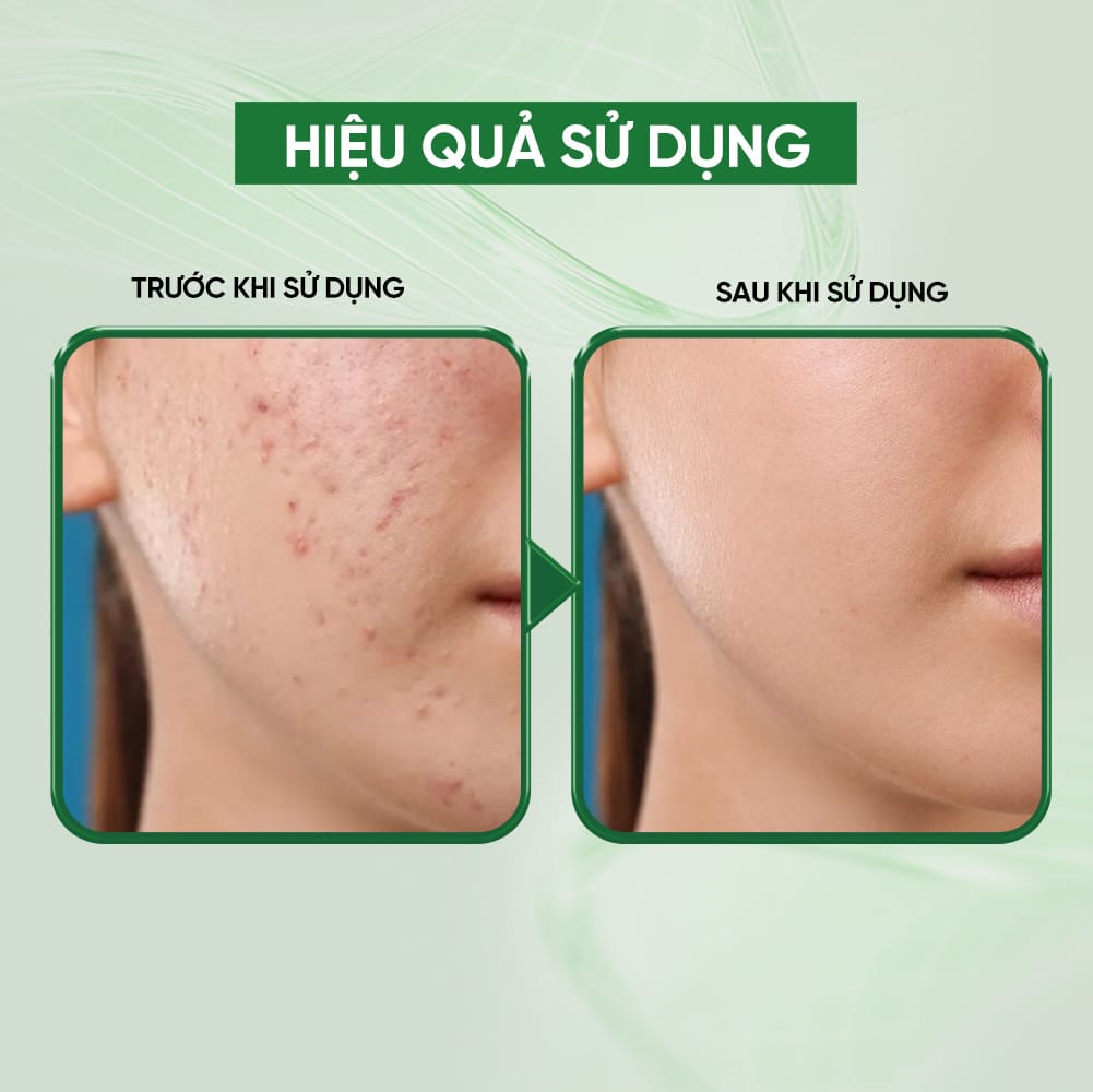 Bioessence Mask T - Mặt Nạ Tràm Trà | Hỗ Trợ Giảm Mụn, Kiểm Soát Dầu, Làm Dịu Da | 10 Miếng x 26ml - Ảnh 4